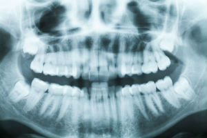 X Rays | Dr. Canter | Anaheim Dentist