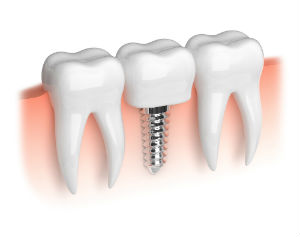 Dental Implants | Dr. Canter | La Habra CA Dentist