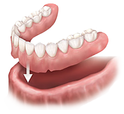 Dentures | Dr. Canter | Anaheim, cA Dentist